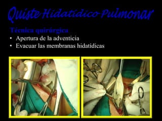 Técnica quirúrgica
• Apertura de la adventicia
• Evacuar las membranas hidatídicas

 