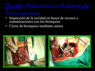 Técnica quirúrgica
• Inspección de la cavidad en busca de recesos o
comunicaciones con los bronquios
• Cierre de bronquios mediante sutura

 