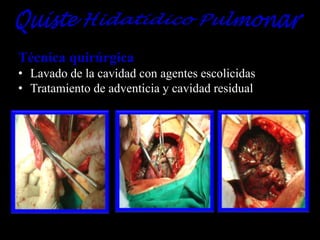 Técnica quirúrgica
• Lavado de la cavidad con agentes escolicidas
• Tratamiento de adventicia y cavidad residual

 