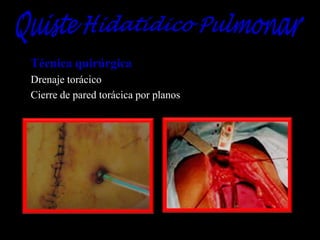 Técnica quirúrgica
Drenaje torácico
Cierre de pared torácica por planos

 