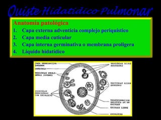 Anatomía patológica
1.
2.
3.
4.

Capa externa adventicia complejo periquístico
Capa media cuticular
Capa interna germinativa o membrana proligera
Liquido hidatídico

 
