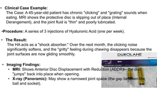 Intra Disc Injection Intra-Articular TMJ Injections111111.pdf