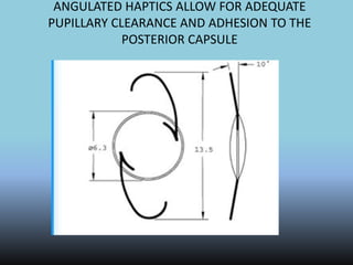 ANGULATED HAPTICS ALLOW FOR ADEQUATE
PUPILLARY CLEARANCE AND ADHESION TO THE
POSTERIOR CAPSULE
 