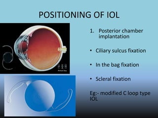 POSITIONING OF IOL
1. Posterior chamber
implantation
• Ciliary sulcus fixation
• In the bag fixation
• Scleral fixation
Eg:- modified C loop type
IOL
 