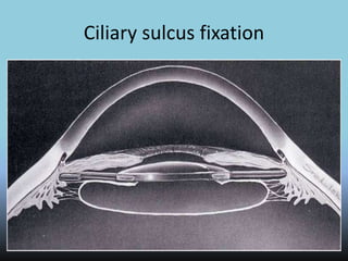 Ciliary sulcus fixation
 