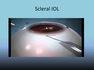 Scleral IOL
 