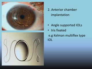 2. Anterior chamber
implantation
• Angle supported IOLs
• Iris fixated
e.g Kelman multiflex type
IOL
 