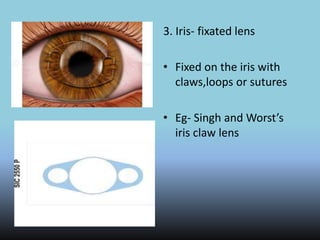 3. Iris- fixated lens
• Fixed on the iris with
claws,loops or sutures
• Eg- Singh and Worst’s
iris claw lens
 