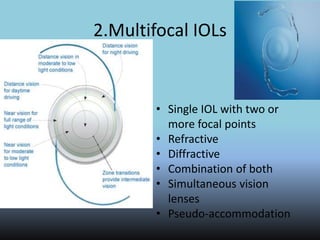 2.Multifocal IOLs
• Single IOL with two or
more focal points
• Refractive
• Diffractive
• Combination of both
• Simultaneous vision
lenses
• Pseudo-accommodation
 