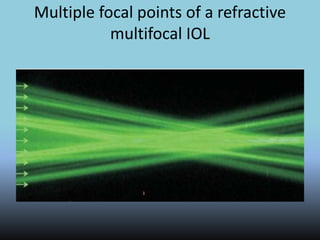 Multiple focal points of a refractive
multifocal IOL
 