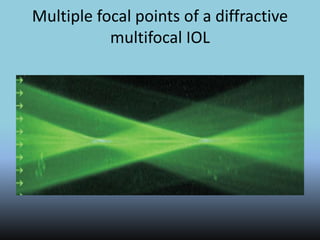 Multiple focal points of a diffractive
multifocal IOL
 