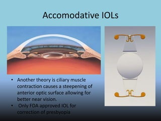 Accomodative IOLs
• Another theory is ciliary muscle
contraction causes a steepening of
anterior optic surface allowing for
better near vision.
• Only FDA approved IOL for
correction of presbyopia
 