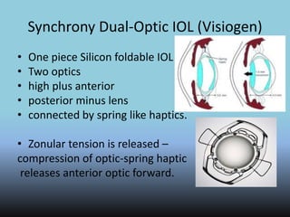 Synchrony Dual-Optic IOL (Visiogen)
• One piece Silicon foldable IOL
• Two optics
• high plus anterior
• posterior minus lens
• connected by spring like haptics.
• Zonular tension is released –
compression of optic-spring haptic
releases anterior optic forward.
 