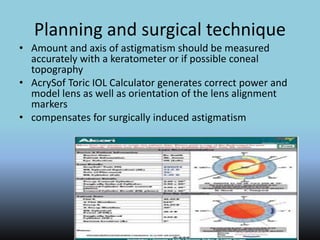 Planning and surgical technique
• Amount and axis of astigmatism should be measured
accurately with a keratometer or if possible coneal
topography
• AcrySof Toric IOL Calculator generates correct power and
model lens as well as orientation of the lens alignment
markers
• compensates for surgically induced astigmatism
 