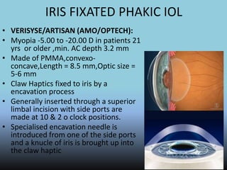 IRIS FIXATED PHAKIC IOL
• VERISYSE/ARTISAN (AMO/OPTECH):
• Myopia -5.00 to -20.00 D in patients 21
yrs or older ,min. AC depth 3.2 mm
• Made of PMMA,convexo-
concave,Length = 8.5 mm,Optic size =
5-6 mm
• Claw Haptics fixed to iris by a
encavation process
• Generally inserted through a superior
limbal incision with side ports are
made at 10 & 2 o clock positions.
• Specialised encavation needle is
introduced from one of the side ports
and a knucle of iris is brought up into
the claw haptic
 