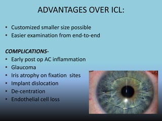 ADVANTAGES OVER ICL:
• Customized smaller size possible
• Easier examination from end-to-end
COMPLICATIONS-
• Early post op AC inflammation
• Glaucoma
• Iris atrophy on fixation sites
• Implant dislocation
• De-centration
• Endothelial cell loss
 