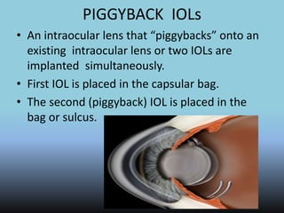 PIGGYBACK IOLs
• An intraocular lens that “piggybacks” onto an
existing intraocular lens or two IOLs are
implanted simultaneously.
• First IOL is placed in the capsular bag.
• The second (piggyback) IOL is placed in the
bag or sulcus.
 