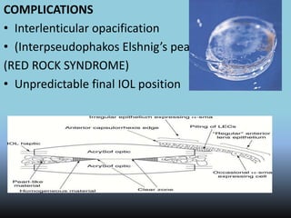 COMPLICATIONS
• Interlenticular opacification
• (Interpseudophakos Elshnig’s pearls)
(RED ROCK SYNDROME)
• Unpredictable final IOL position
 