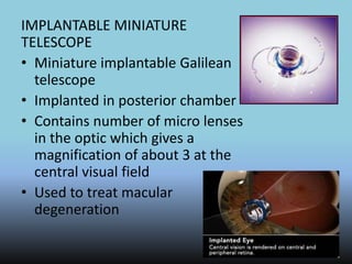 IMPLANTABLE MINIATURE
TELESCOPE
• Miniature implantable Galilean
telescope
• Implanted in posterior chamber
• Contains number of micro lenses
in the optic which gives a
magnification of about 3 at the
central visual field
• Used to treat macular
degeneration
 