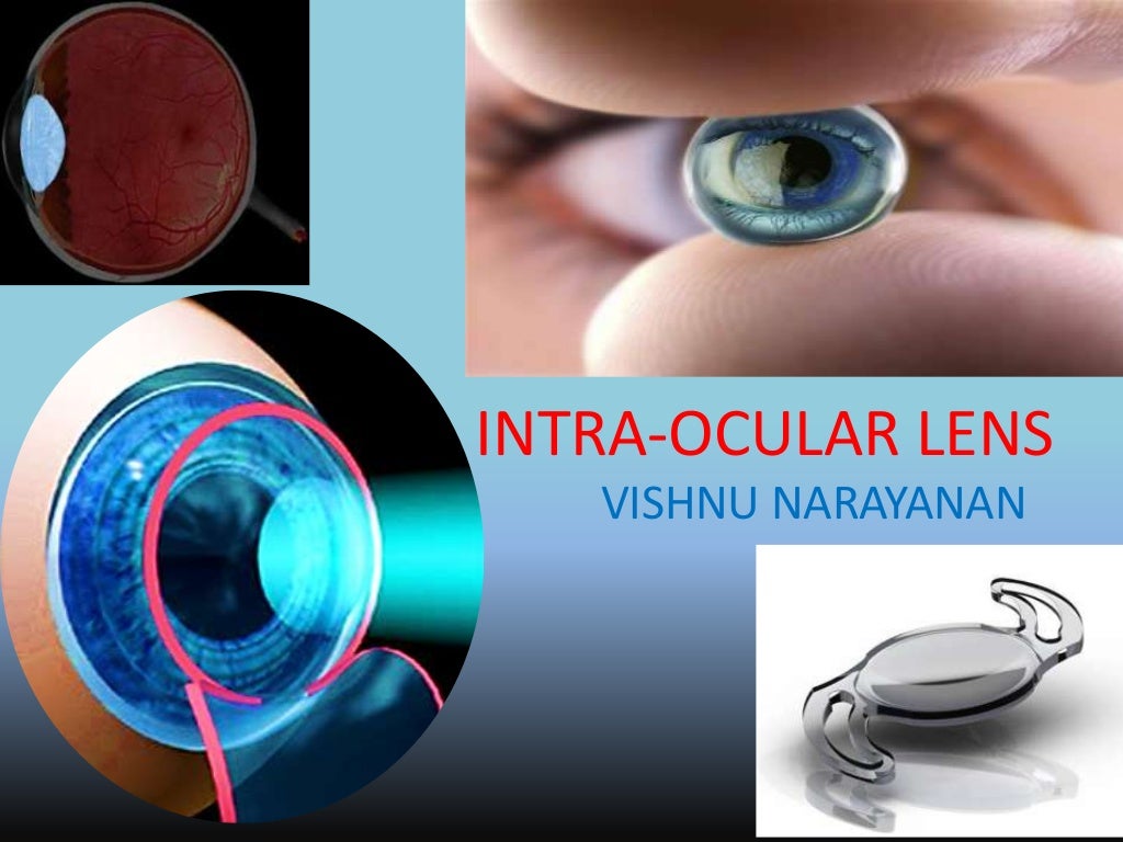 Intra ocular lens