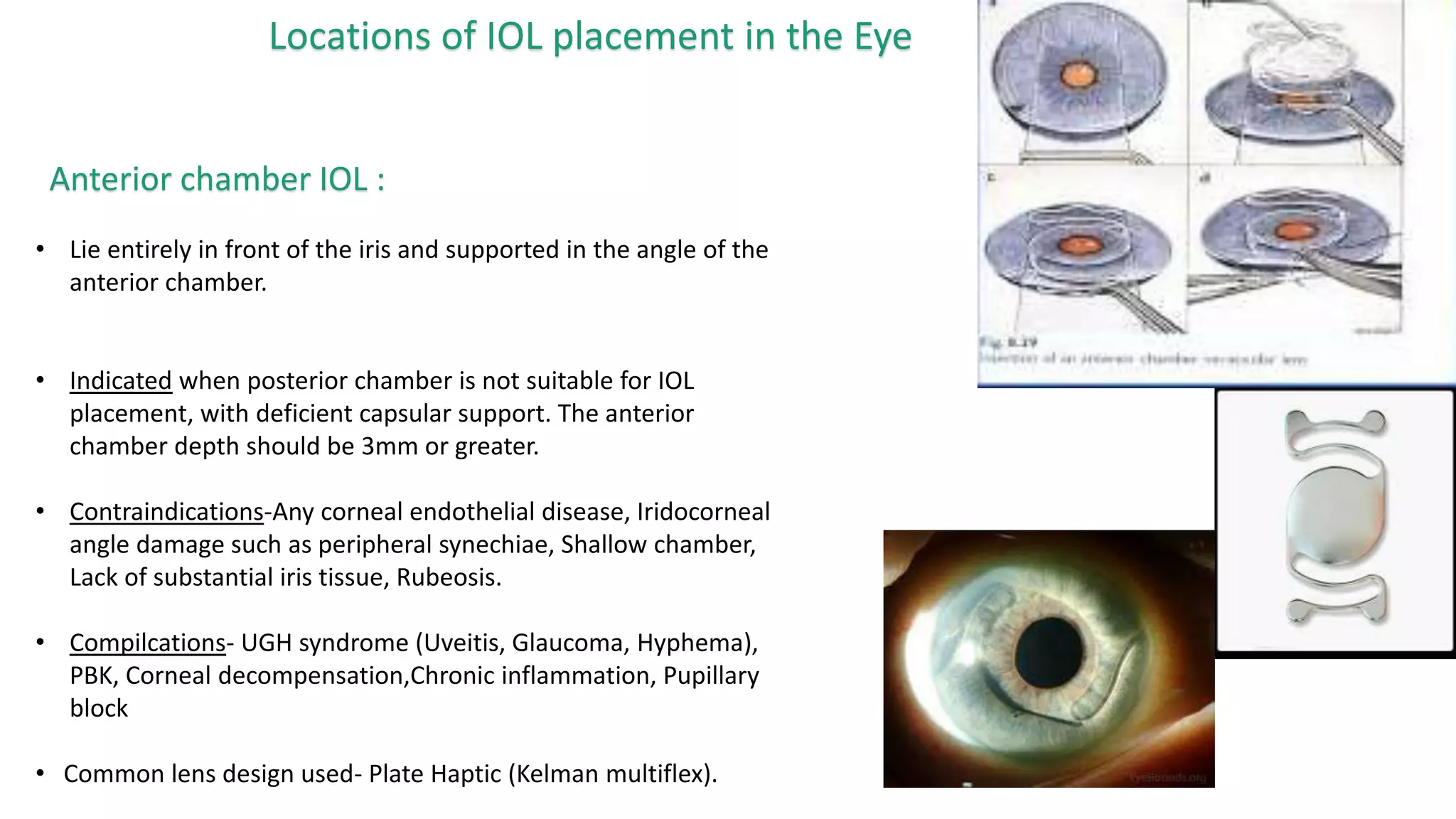Locations of IOL placement in the Eye
• Lie entirely in front of the iris and supported in the angle of the
anterior chamber.
• Indicated when posterior chamber is not suitable for IOL
placement, with deficient capsular support. The anterior
chamber depth should be 3mm or greater.
• Contraindications-Any corneal endothelial disease, Iridocorneal
angle damage such as peripheral synechiae, Shallow chamber,
Lack of substantial iris tissue, Rubeosis.
• Compilcations- UGH syndrome (Uveitis, Glaucoma, Hyphema),
PBK, Corneal decompensation,Chronic inflammation, Pupillary
block
• Common lens design used- Plate Haptic (Kelman multiflex).
Anterior chamber IOL :
 