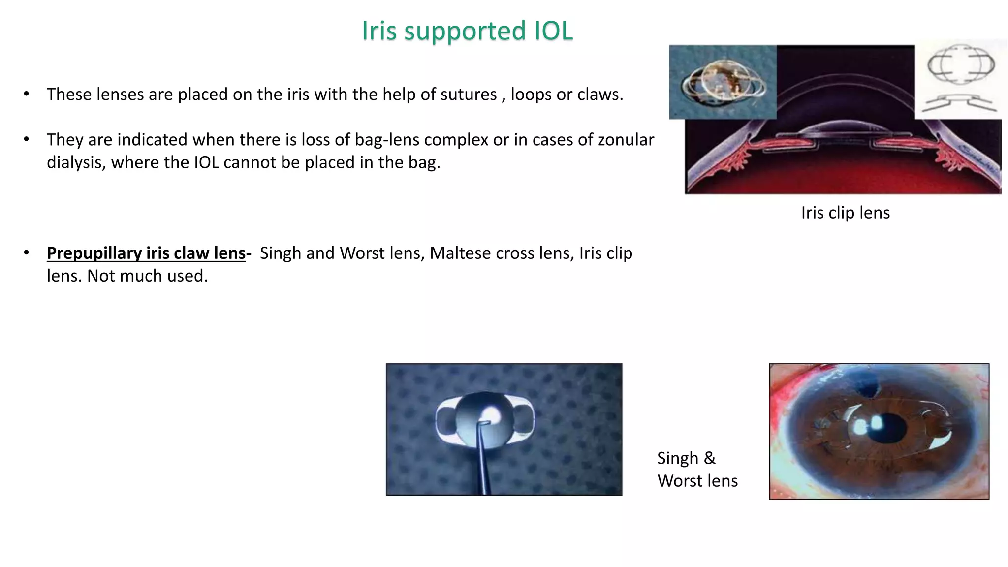 Iris supported IOL
• These lenses are placed on the iris with the help of sutures , loops or claws.
• They are indicated when there is loss of bag-lens complex or in cases of zonular
dialysis, where the IOL cannot be placed in the bag.
• Prepupillary iris claw lens- Singh and Worst lens, Maltese cross lens, Iris clip
lens. Not much used.
Iris clip lens
Singh &
Worst lens
 