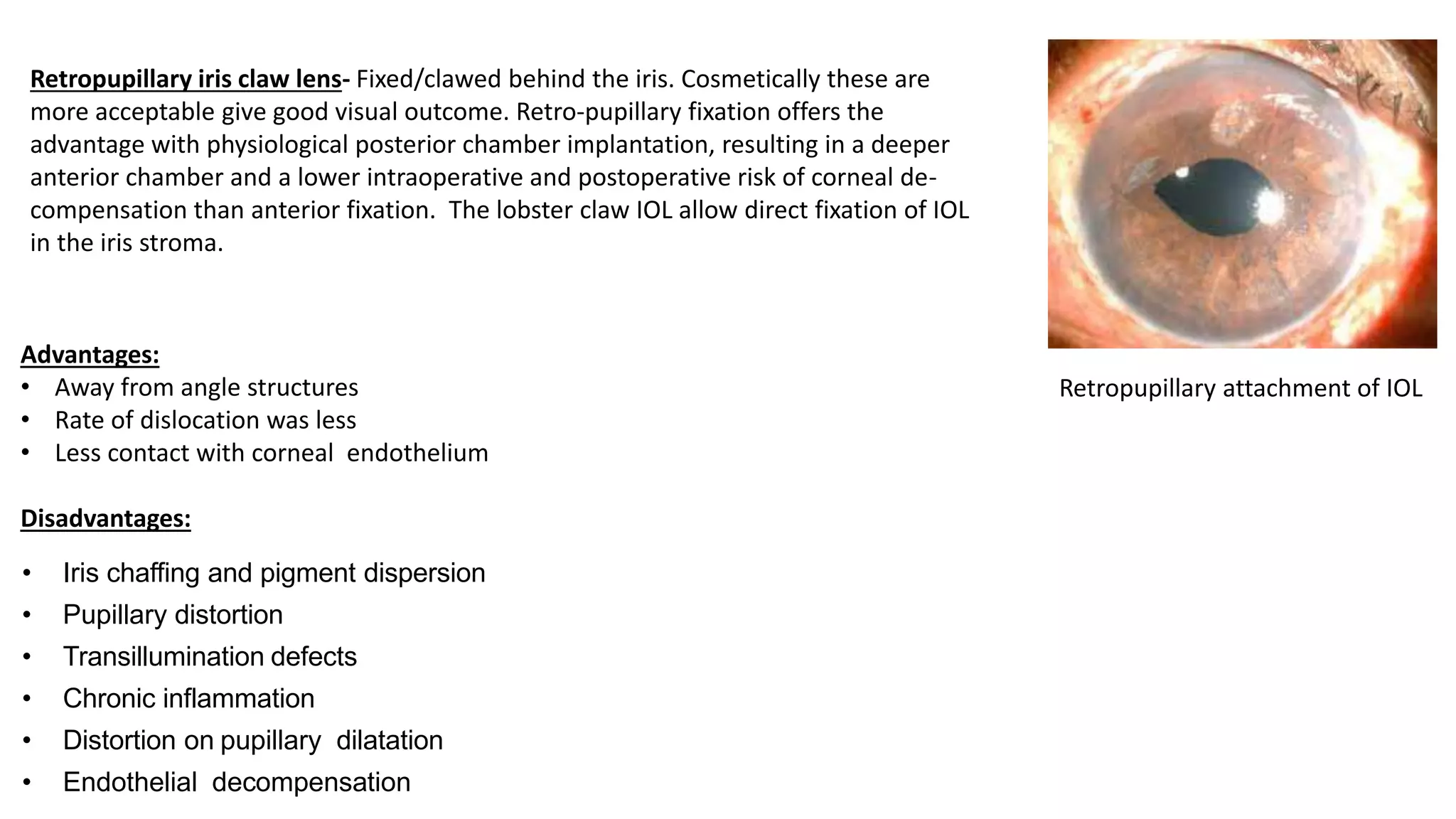 Retropupillary iris claw lens- Fixed/clawed behind the iris. Cosmetically these are
more acceptable give good visual outcome. Retro-pupillary fixation offers the
advantage with physiological posterior chamber implantation, resulting in a deeper
anterior chamber and a lower intraoperative and postoperative risk of corneal de-
compensation than anterior fixation. The lobster claw IOL allow direct fixation of IOL
in the iris stroma.
Advantages:
• Away from angle structures
• Rate of dislocation was less
• Less contact with corneal endothelium
Disadvantages:
• Iris chaffing and pigment dispersion
• Pupillary distortion
• Transillumination defects
• Chronic inflammation
• Distortion on pupillary dilatation
• Endothelial decompensation
Retropupillary attachment of IOL
 
