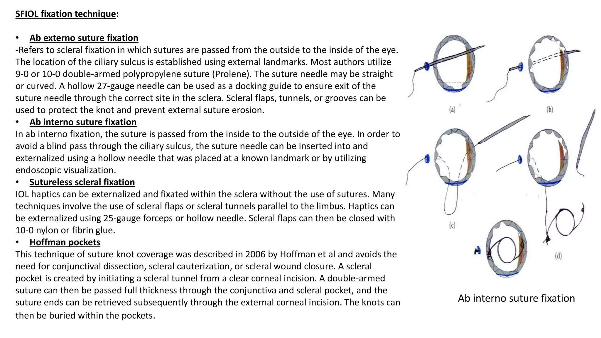 SFIOL fixation technique:
• Ab externo suture fixation
-Refers to scleral fixation in which sutures are passed from the outside to the inside of the eye.
The location of the ciliary sulcus is established using external landmarks. Most authors utilize
9-0 or 10-0 double-armed polypropylene suture (Prolene). The suture needle may be straight
or curved. A hollow 27-gauge needle can be used as a docking guide to ensure exit of the
suture needle through the correct site in the sclera. Scleral flaps, tunnels, or grooves can be
used to protect the knot and prevent external suture erosion.
• Ab interno suture fixation
In ab interno fixation, the suture is passed from the inside to the outside of the eye. In order to
avoid a blind pass through the ciliary sulcus, the suture needle can be inserted into and
externalized using a hollow needle that was placed at a known landmark or by utilizing
endoscopic visualization.
• Sutureless scleral fixation
IOL haptics can be externalized and fixated within the sclera without the use of sutures. Many
techniques involve the use of scleral flaps or scleral tunnels parallel to the limbus. Haptics can
be externalized using 25-gauge forceps or hollow needle. Scleral flaps can then be closed with
10-0 nylon or fibrin glue.
• Hoffman pockets
This technique of suture knot coverage was described in 2006 by Hoffman et al and avoids the
need for conjunctival dissection, scleral cauterization, or scleral wound closure. A scleral
pocket is created by initiating a scleral tunnel from a clear corneal incision. A double-armed
suture can then be passed full thickness through the conjunctiva and scleral pocket, and the
suture ends can be retrieved subsequently through the external corneal incision. The knots can
then be buried within the pockets.
Ab interno suture fixation
 