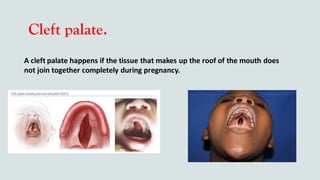 Cleft palate.
A cleft palate happens if the tissue that makes up the roof of the mouth does
not join together completely during pregnancy.
 
