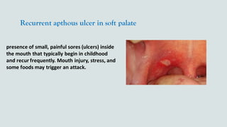 Recurrent apthous ulcer in soft palate
presence of small, painful sores (ulcers) inside
the mouth that typically begin in childhood
and recur frequently. Mouth injury, stress, and
some foods may trigger an attack.
 