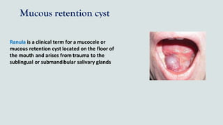 Mucous retention cyst
Ranula is a clinical term for a mucocele or
mucous retention cyst located on the floor of
the mouth and arises from trauma to the
sublingual or submandibular salivary glands
 