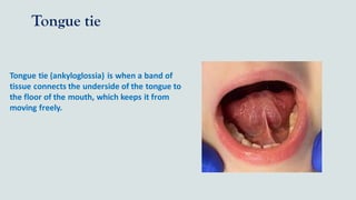 Tongue tie
Tongue tie (ankyloglossia) is when a band of
tissue connects the underside of the tongue to
the floor of the mouth, which keeps it from
moving freely.
 
