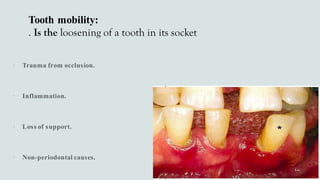 Tooth mobility:
. Is the loosening of a tooth in its socket




 