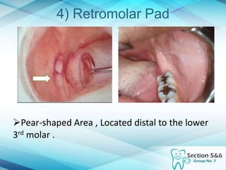 4) Retromolar Pad
Pear-shaped Area , Located distal to the lower
3rd molar .
 