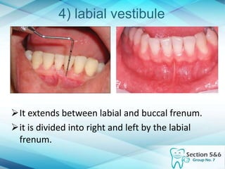 4) labial vestibule
It extends between labial and buccal frenum.
it is divided into right and left by the labial
frenum.
 