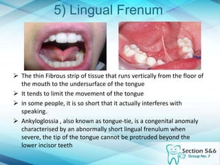 5) Lingual Frenum
 The thin Fibrous strip of tissue that runs vertically from the floor of
the mouth to the undersurface of the tongue
 It tends to limit the movement of the tongue
 in some people, it is so short that it actually interferes with
speaking.
 Ankyloglossia , also known as tongue-tie, is a congenital anomaly
characterised by an abnormally short lingual frenulum when
severe, the tip of the tongue cannot be protruded beyond the
lower incisor teeth
 