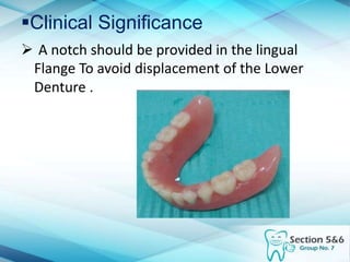 Clinical Significance
 A notch should be provided in the lingual
Flange To avoid displacement of the Lower
Denture .
 