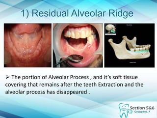 1) Residual Alveolar Ridge
 The portion of Alveolar Process , and it’s soft tissue
covering that remains after the teeth Extraction and the
alveolar process has disappeared .
 
