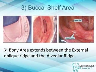 3) Buccal Shelf Area
 Bony Area extends between the External
oblique ridge and the Alveolar Ridge .
 