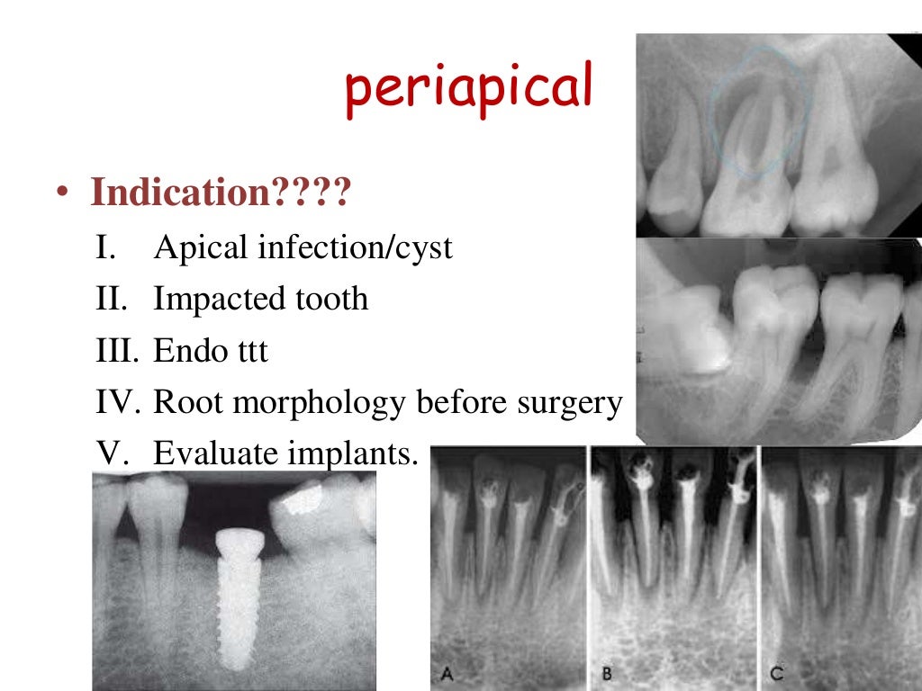 Intra oral radiograph techniques