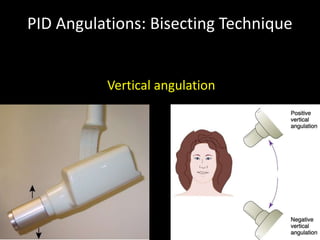 PID Angulations: Bisecting Technique
Vertical angulation
 