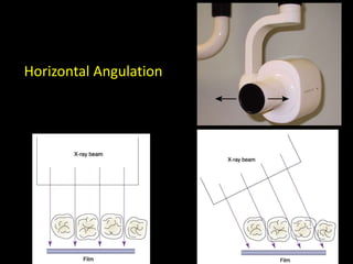 Horizontal Angulation
 