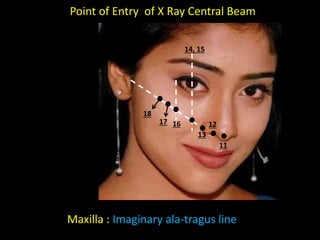11
12
13
16
17
18
14, 15
Maxilla : Imaginary ala-tragus line
Point of Entry of X Ray Central Beam
 