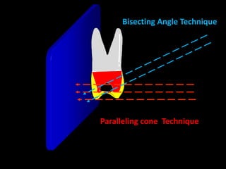 Bisecting Angle Technique
Paralleling cone Technique
 