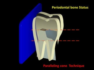 Paralleling cone Technique
Periodontal bone Status
 