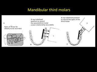 Mandibular third molars
 