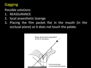 Possible solutions:
1. REASSURANCE
2. local anaesthetic lozenge
3. Placing the film packet flat in the mouth (in the
occlusal plane) so it does not touch the palate.
Gagging
 