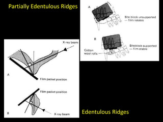 Edentulous Ridges
Partially Edentulous Ridges
 