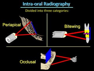 Intra-oral Radiography
Periapical Bitewing
Occlusal
Divided into three categories:
 