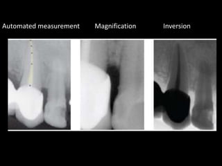 Automated measurement Inversion
Magnification
 
